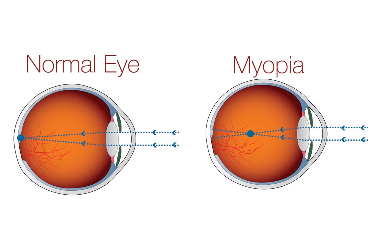 Myopia Treatment Short Sightedness Melbourne NewVision